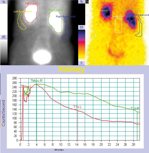 medycyna nuklearna \ nuclear medicine artykuł \ article kanalików bliższych nefronów. Około 10-15% dawki radiofarmaceutyku przechodzi do wnętrza komórek kanalików i nie podlega wydzielaniu z moczem.