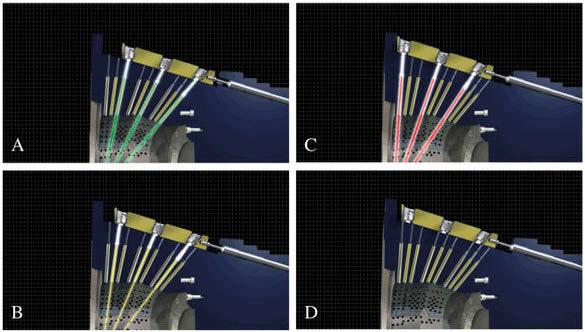 radioterapia \ radiotherapy artykuł naukowy \ scientific paper Wprowadzenie Leczenie w urządzeniu Gamma Knife Radiochirurgia stereotaktyczna z użyciem Gamma Knife to metoda radioterapii,