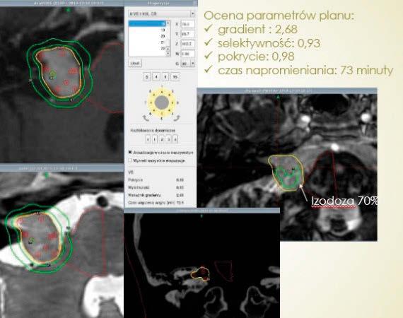 artykuł naukowy / scientific paper radioterapia / radiotherapy należy pamiętać o uzupełnianiu kapilar płynem, tak aby nie było w nich pęcherzyków powietrza.