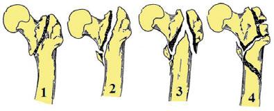 implantologia \ implantology artykuł \ article Złamanie przezkrętarzowe kości udowej numeryczna analiza stabilności Jakub Słowiński 1, Grzegorz Ziółkowski 2, Konrad Kudłacik 3 1 Katedra Mechaniki i