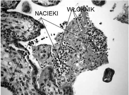 Ginekol Pol. 2010, 81, 435-440 P R A C E O R Y G I N A L N E Ocena wybranych wykładników morfologicznych zapalenia w popłodach.