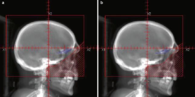 wykorzystane przy HA-WBRT (radioterapia z ochroną hipokampa); PTV mózg-(hipokam+3 mm); hipokamp najlepiej widoczny w sekwencji T1 MR; atlas