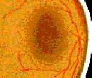 Normal Macula Dry