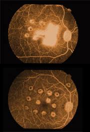 under the Macula Wet