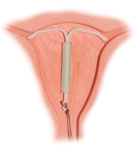 Wkładka hormonalna Obraz: https://commons.