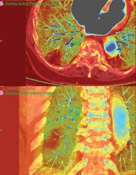niediagnostycznej. Wysokoenergetyczne obrazy MonoE redukują obecne obrazach CT artefakty pochodzące od metalowych implantów i poprawiają jakość obrazu.