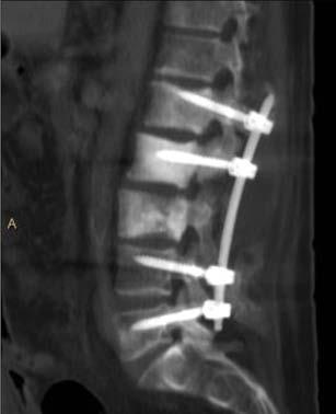 artefaktów pochodzących od metalowych implantów w celu poprawy jakości obrazu MAR (redukcja artefaktów pochodzących od metalowych implantów) Jak pokazano na powyższym obrazie wysokoenergetyczne