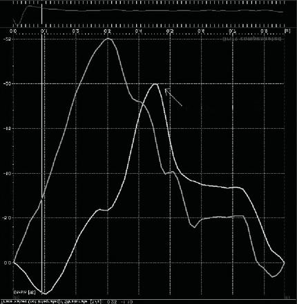 Folia Cardiologica Excerpta 2009, tom 4, nr 4 Rycina 2. Krzywa odkształcenia dla objętych zawałem fragmentów mięśnia sercowego (niebieska linia) oraz segmentów referencyjnych (biała linia).