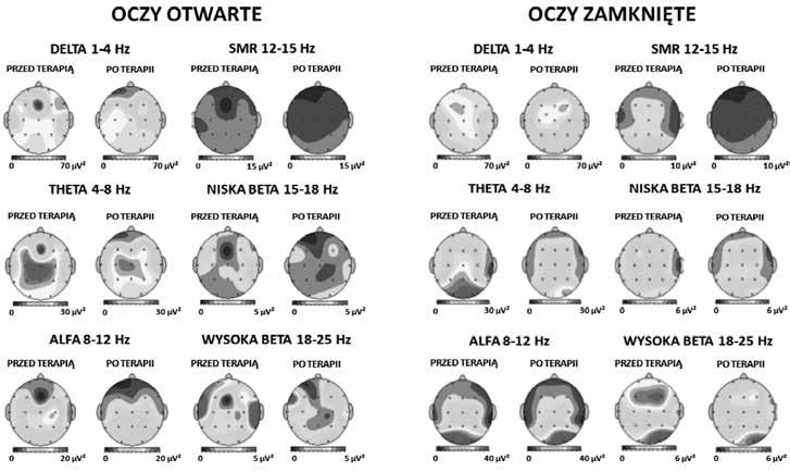 178 Małgorzata Ganc, Rafał Milner, Wiesław Wiktor Jędrzejczak, Henryk Skarżyński Zmiany w sygnałach EEG zarejestrowanych przy oczach otwartych Po zakończeniu terapii EEG Biofeedback, w sygnale EEG