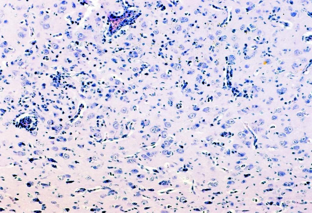 6). Reakcjom naczyniowym towarzyszy³y ró nie nasilone zmiany wsteczne neurocytów. Obraz ten odpowiada³ zmianom charakterystycznym dla AE (1, 2, 8-10, 16).