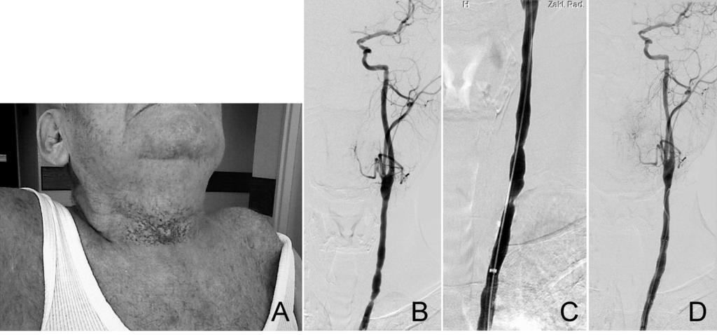 Stent antebrain art radiother laryng cancer, Jargiełło et al. ties were detected in the right-sided carotid arteries, and both vertebral arteries were broad with normal cephalad blood flow.