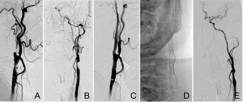 Stent antebrain art radiother laryng cancer, Jargiełło et al. Figure 2A. Initial arteriographic picture in lateral projection. B. An arteriographic picture in postero-anterior projection.