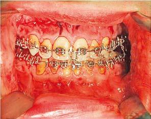 Intermaxillary fixation Znieczulenie ogólne pacjentów poddanych zabiegom ortognatycznym (wskazania: korekta zniekształceń twarzowo-szczękowo-zgryzowych) jest w swojej specyfice odmienne od