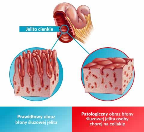 Nieszczelność jelit czy może po prostu celiakia? Wiele mówi się o nieszczelności jelit przy chorobie Hashimoto, choć tak naprawdę nie ma żadnych dowodów naukowych, że takie schorzenie istnieje.