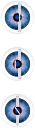 SKIASKOPY [ 047 ] Tęczówka Źrenica Refl eks siatkówkowy Obraz szczeliny poza źrenicą W kierunku ruchu Hyperopia / Presbyopia W kierunku odwrotnym Myopia Ręczne skiaskopy do badania refrakcji.