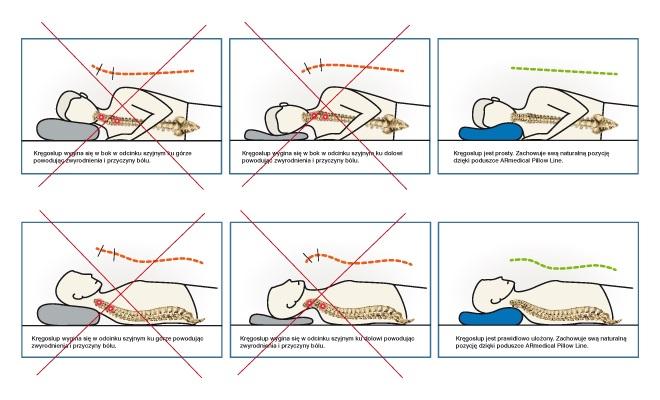 Ilustracja 3: Ustawienie odcinka szyjnego kręgosłupa na nie odpowiedniej poduszce oraz prawidłowe ustawienie na poduszce. Niestety ból odcinka szyjnego bardzo często dokucza pacjentom w nocy.