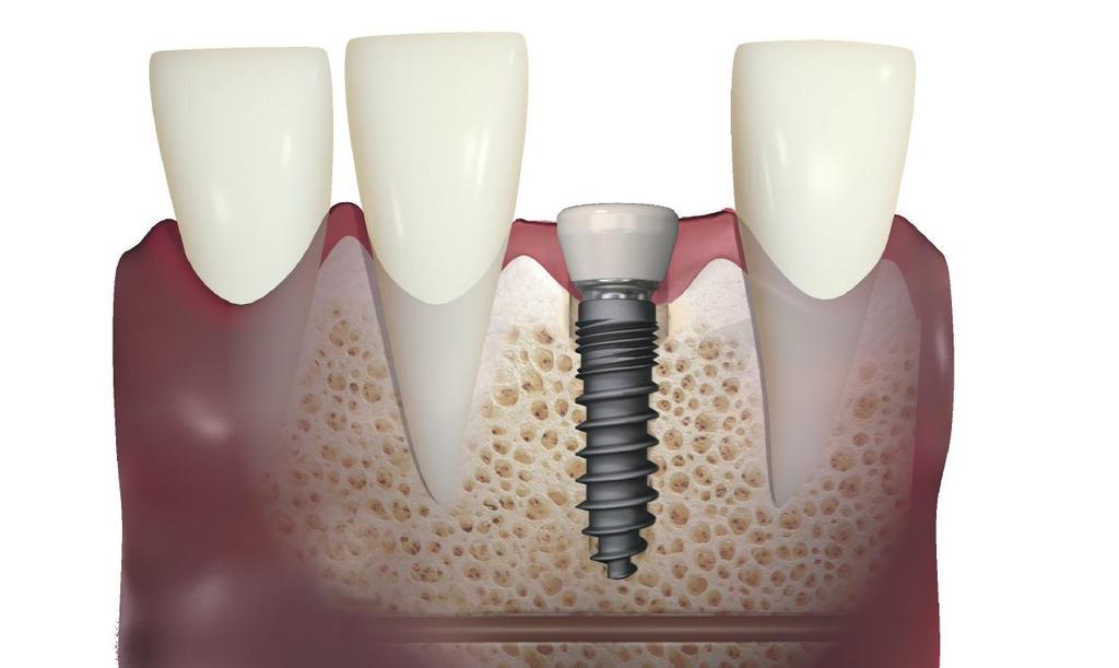 Minimalnie Inwa MIMI Łagodna i bezpieczna metoda implantacji Odpowiedzi na 10