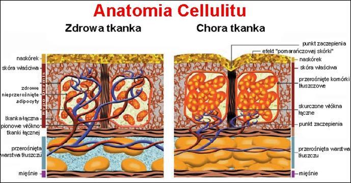 Cellulit - ganoid lipodystrophy (GLD), lipodystrofia typu kobiecego, zmiany zwyrodnieniowe tkanki podskórnej, guzkowe twardniejące