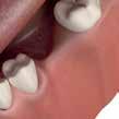 tytanu Strona 8 Champions CEREC