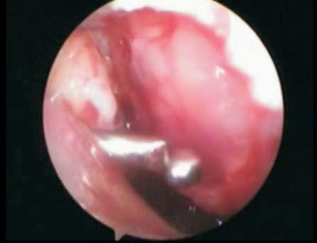 No sport discipline requiring considerable weighting of the knee joint was recommended up to a year from articular chondrus transplantation.
