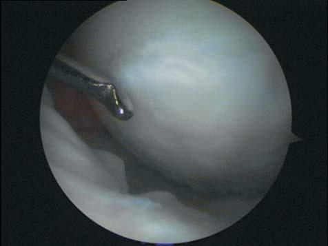 Further observations on the use of autological chondrocytes in the treatment of damages of knee joint cartilage 73 No infectious complications were observed in none of the patients.