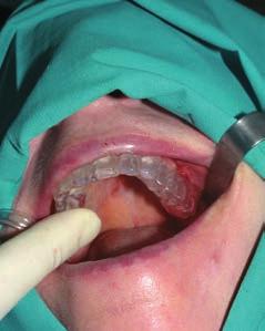 Korony na zębach filarowych były wsunięte poddziąsłowo, występowało krwawienie z dziąseł. Stwierdzono znaczne rozchwianie zębów.