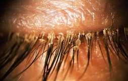 Obraz kliniczny blepharitis, nawracające