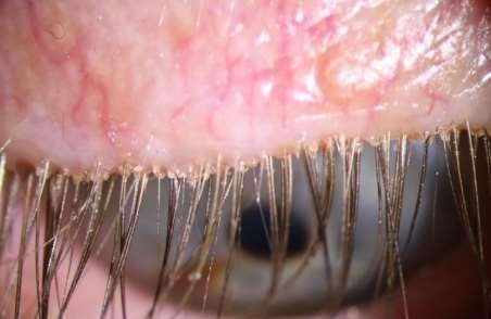 Główne objawy blepharitis: zaczerwienie i obrzęk brzegów powiek, świąd, dyskomfort Zapalenie brzegów powiek wywołane przez nużeńce charakteryzuje się różnym stopniem nasilenia objawów