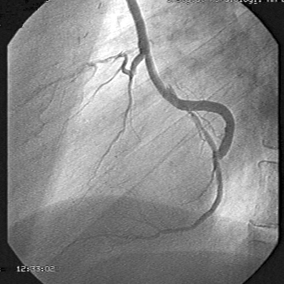 zstępującą (RA-RDP, radial artery anastomosed to right posterior descendens coronary artery), a na rycinie 7 pomost żylny z gałęzią skośną i brzegiem tępym (SVG-Diag i MO, venous graft anastomosed to