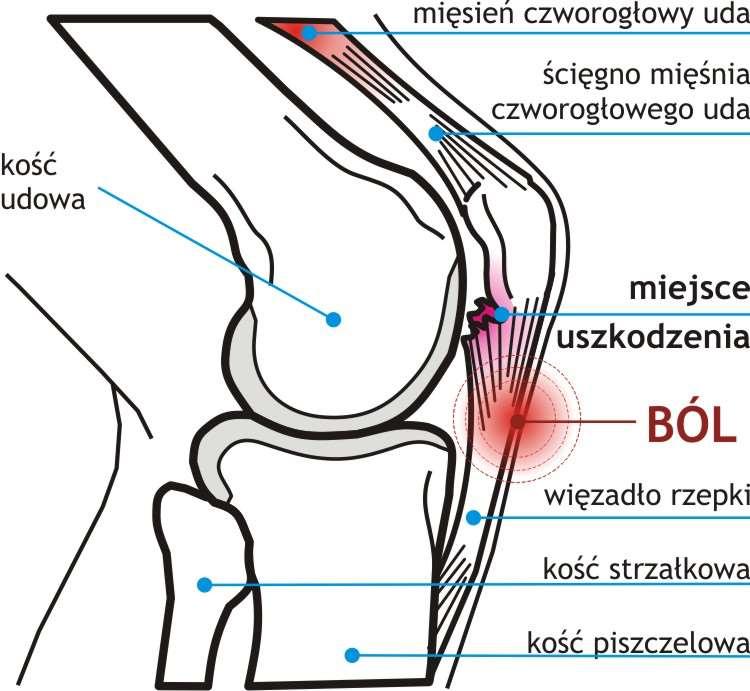 Zrzucanie stabilizacji biodra