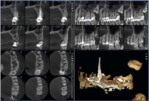 Kluczowe funkcje Zaawansowana Nigdy nie stracisz ujęcia w aparatach CBCT Planmeca Bez korekcji artefaktów poruszeń Z algorytmem usuwania poruszeń Planmeca CALM technologia Inteligentne, zaawansowane