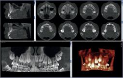 Unikalny i pionierski protokół obrazowania opiera się na inteligentnych algorytmach 3D opracowanych przez Planmeca.