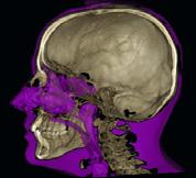 Superimpozycja CBCT Nowość w Planmeca Romexis 3D, moduł umożliwia nakładanie na siebie dwóch obrazów CBCT. Jest to wartościowe narzędzie do porównań przed i po zabiegu, które można używać np.