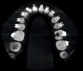 Moduł ten w ogromnym stopniu ułatwia analizę modeli dentystycznych, zapewniając wszystkie niezbędne narzędzia do utworzenia wirtualnej podstawy, zbadania zamknięcia oraz wszechstronnych pomiarów