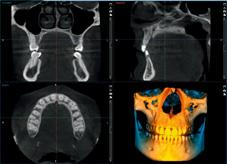 CBCT zapewnia znacznie lepsze możliwości diagnostyczne do badań przesiewowych dla ognisk zakaźnych u pacjentów z niejasnymi objawami lub niektórych chorób ogólnoustrojowych.