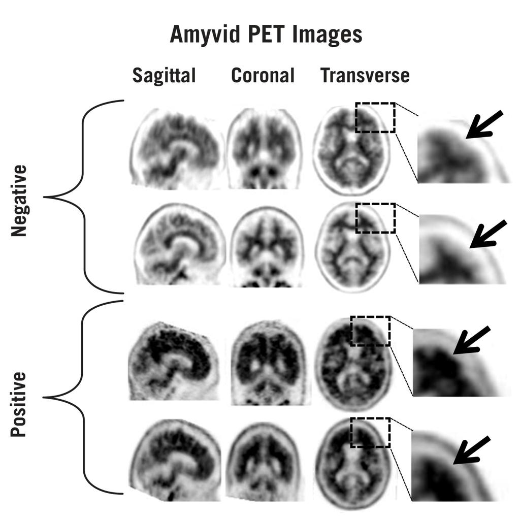 Rycina 1: Przykładowe ujemne (dwa górne rzędy) i dodatnie (dwa dolne rzędy) obrazy uzyskane techniką PET z zastosowaniem produktu Amyvid.