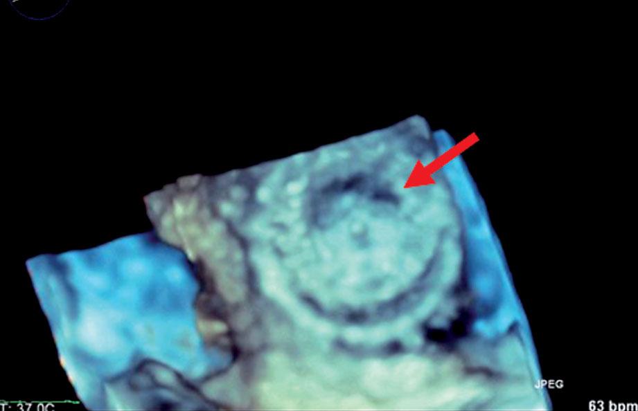 echocardiographic transducer).