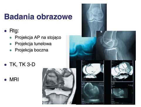 Application of allogenic massive osteo-cartilaginous grafts in the therapy of deep defects of articular surfaces 63 a separating layer a collagen membrane or periosteum, constituting a border between