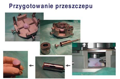 Technique of massive osteo-cartilaginous graft (Mega- OATS) with an application of a graft, allows simultaneous restoration of the osseous defect, the supporting subcartilaginous layer and the