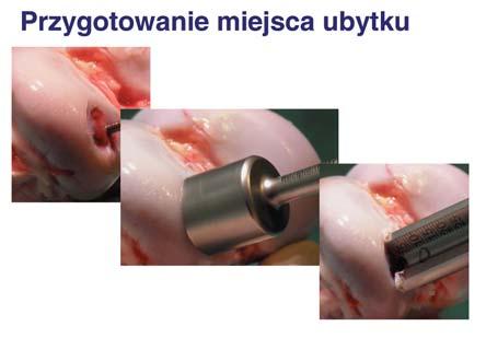 Application of allogenic massive osteo-cartilaginous grafts in the therapy of deep defects of articular surfaces 65 c. Cross milling cutters with cutting depth markers d.