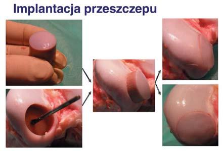 Spheric mallet for the graft OPERATION TECHNIQUE OF MASSIVE OSTEO-CARTILAGINOUS GRAFT A fresh osteo-cartilaginous graft, harvested from an organ donor, can be implanted within 48 hours from its