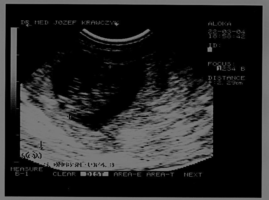 Suplement klinicznie istotnych aneuploidii, wad serca, dysplazji szkieletowych i innych zespołów wad genetycznych [10]. Ryc. 1. Diagnoza ciąży heterotopowej w I trymestrz ciąży.