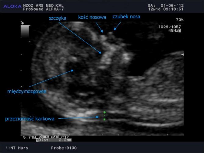 Wstęp 1. Wstęp 1.1 Diagnostyka prenatalna I trymestru Przedstawiona praca została wykonana w ramach realizowanego w Polsce Programu Badań Prenatalnych dla pierwszego trymestru ciąży.