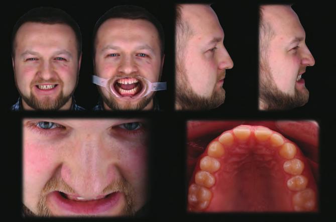 2 Zdjęcia an face przy ustach zamkniętych, lekko rozchylonych