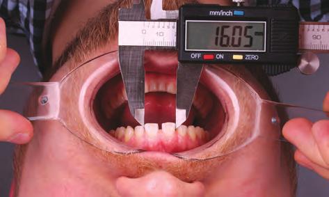 Istnieje możliwość monitoringu pracy przez technika dentystycznego poprzez wykonanie zdjęcia wewnątrzustnego z mock- -up, które następnie eksportuje się do protokołu DSD i nakłada na projekt (Ryc.