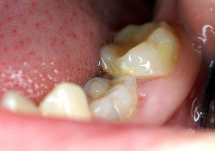 Pacjentka została objęta leczeniem ortodontycznym. Przypadek III Prezentowany na fot. 9-12 przypadek kliniczny dokumentuje obecność zębów reinkludowanych 84 i 85.