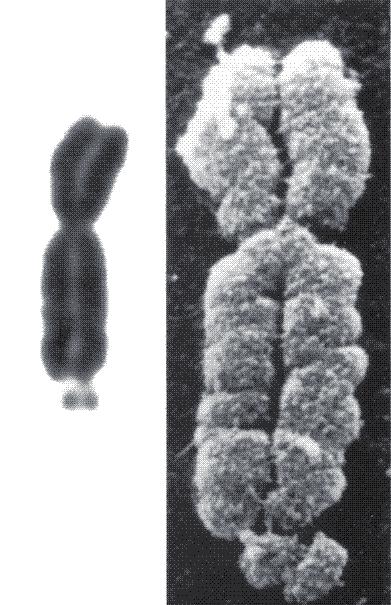 Łamliwe miejsca chromosomu 137 Miejsce łamliwe Ryc. 1. Zespół łamliwego chromosomu X (Medicine World 2007). podczas trwania hodowli tkankowej (Durkin i Glover 2007).