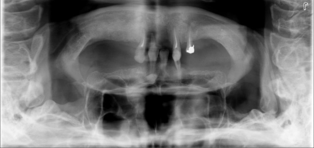 J Stoma 2013; 66, 3 Loster J., Wieczorek A. cancer and cancer recurrence with the most recent surgery taking place in 2009. At that time, the reconstruction of nasal septum was made.