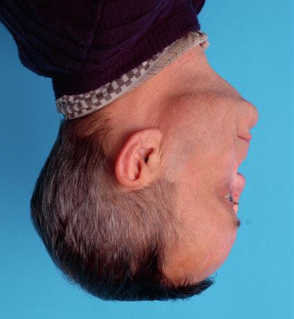 1 a, b, c). Fig. 1. The view of patient s face prior to treatment: a full face, b semiprofile, c profile. Obraz twarzy pacjenta przed leczeniem; a na wprost, b z półprofilu, c z profilu.