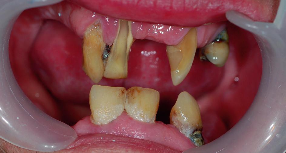 endodontically treated, and tooth 42 had an apical lesion (Fig. 2). During intraoral initial examination, poor oral hygiene was observed plaque and calculus deposits, dental caries and periodontitis.